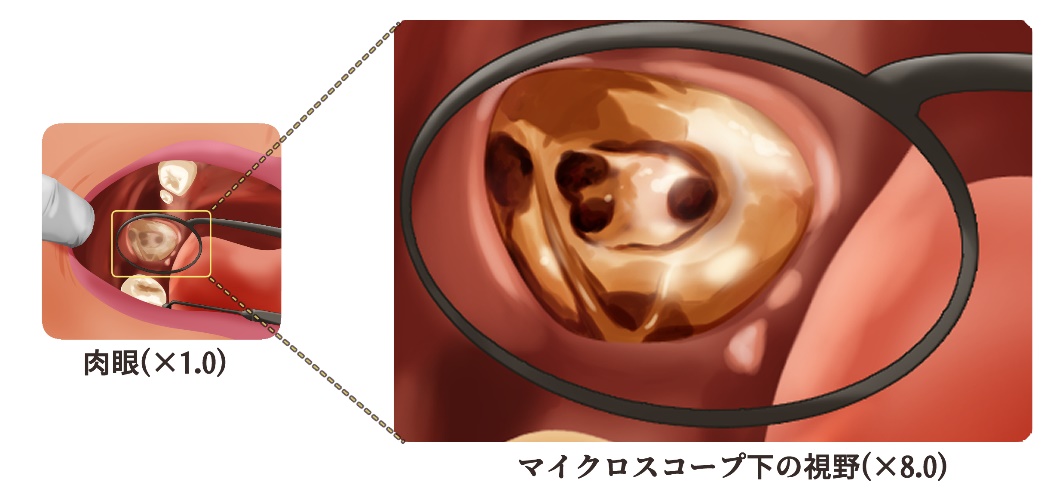歯の根の治療（根管治療）
