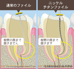 歯の根の治療（根管治療）