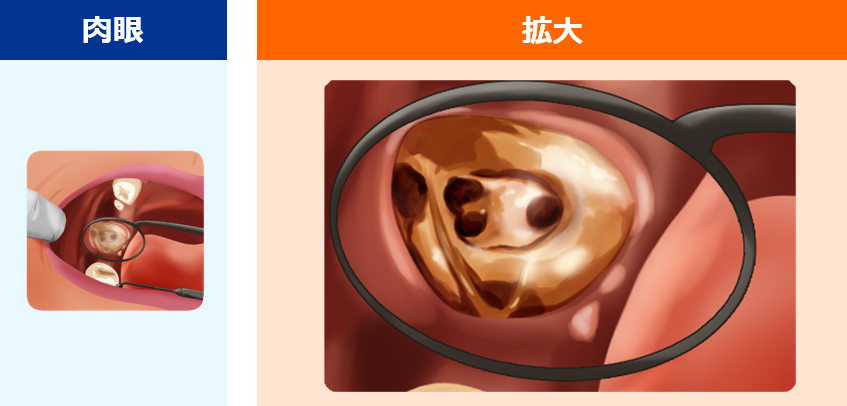 歯の根の治療（根管治療）