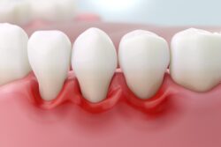 歯周病でインビザラインの治療ができない歯