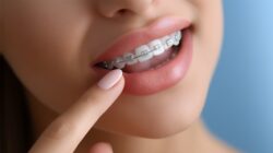 ワイヤー矯正をしている女性の口元