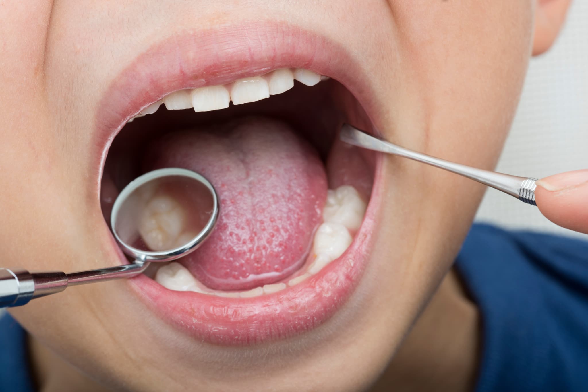 歯科医院で歯のチェックを受ける子供