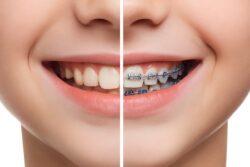 ワイヤー矯正中と矯正後の子どもの歯並び