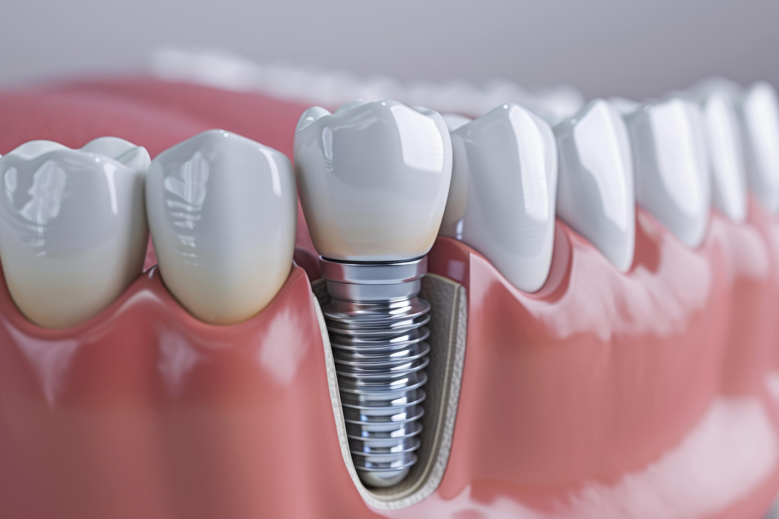インプラントの歯