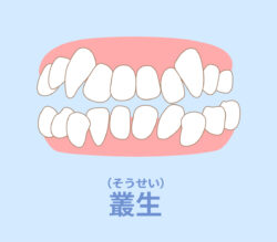 八重歯の構造